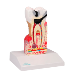 Model zubního kazu 10× zvětšený