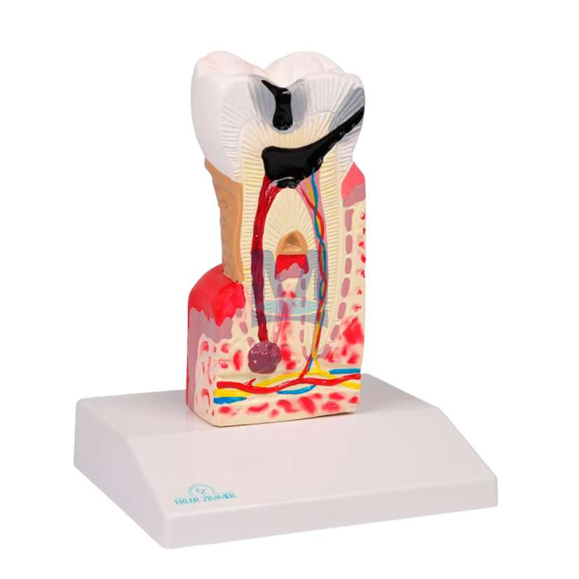 Model zubního kazu 10× zvětšený